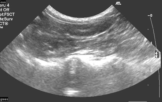 Sonogram of a unilateral cryptorchid one year old Yorkshire Terrier with an intra-abdominal testis