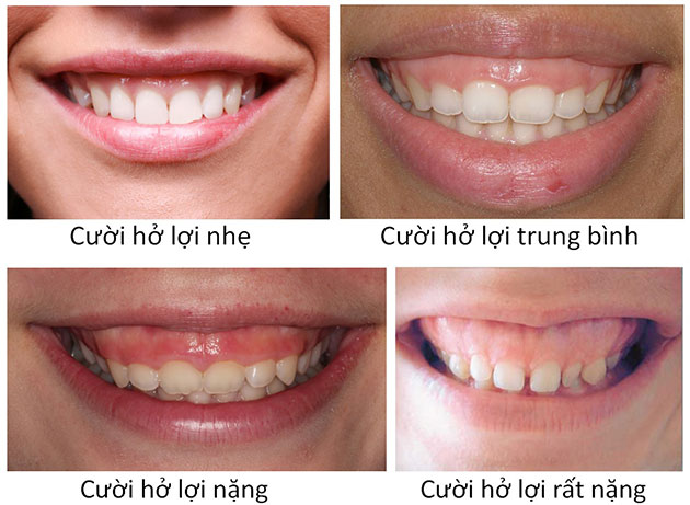 Làm thế nào để khắc phục tình trạng cười hở lợi ở trẻ chưa thành niên