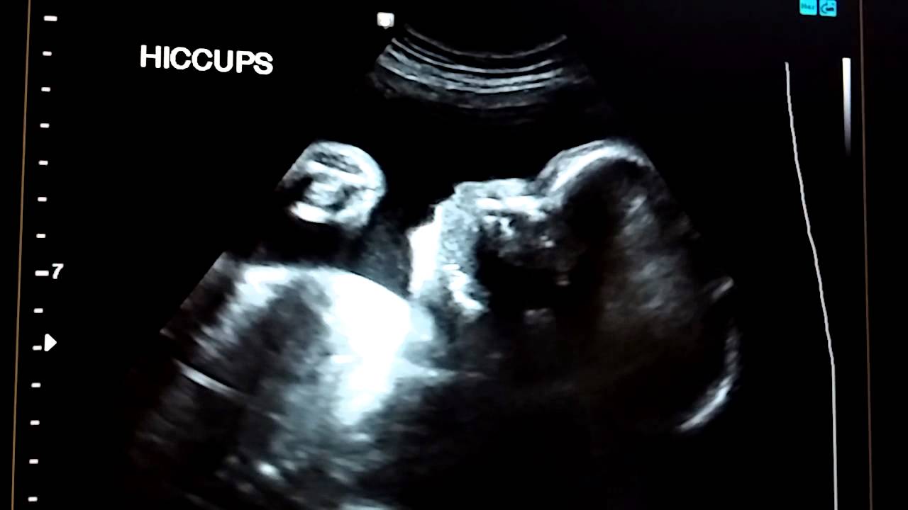 baby hiccups in x-ray