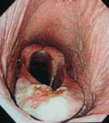Epiglotis atrapada ulcerada.