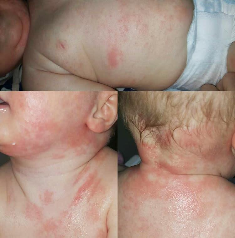 https://o.remove.bg/uploads/9de92d6a-4cc8-4518-a557-8c09221e539b/baby-eczema-1-750x750.jpg