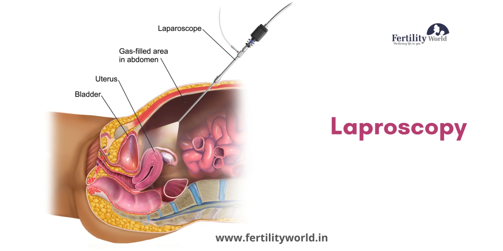Laparoscopic cost in India