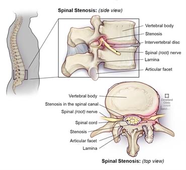 Cervical-spinal-stenosis