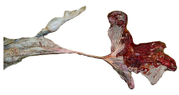 The allantoic portion of the second placenta's umbilical cord. The membranes are extended to the left