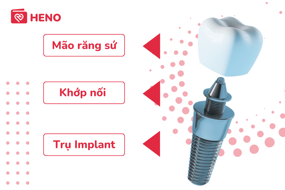 cấu tạo răng implant