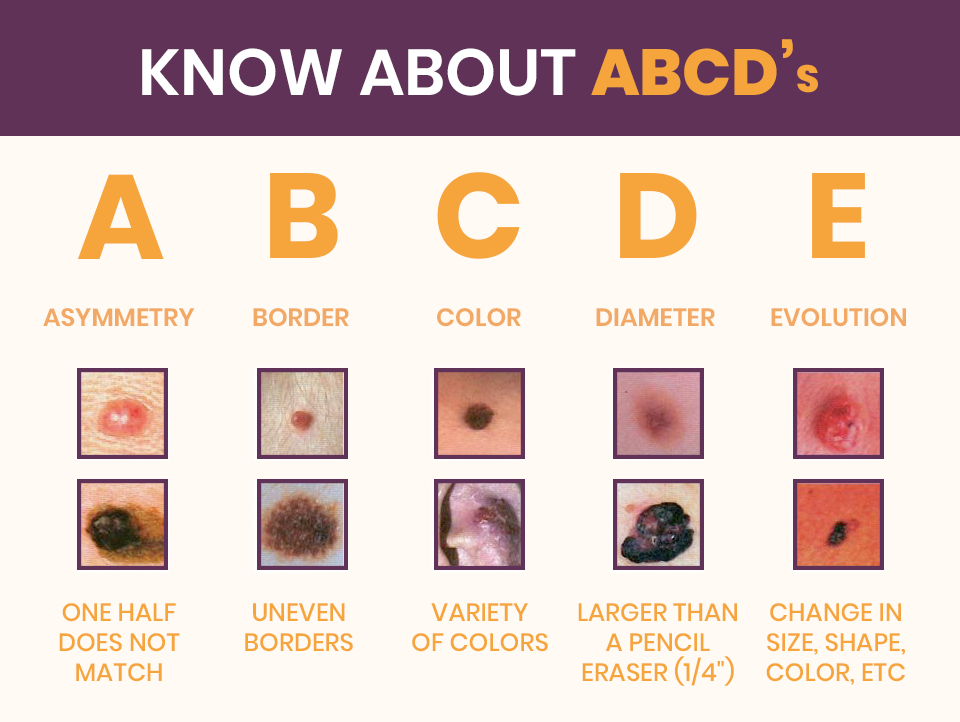 Main Types Of Skin Cancer