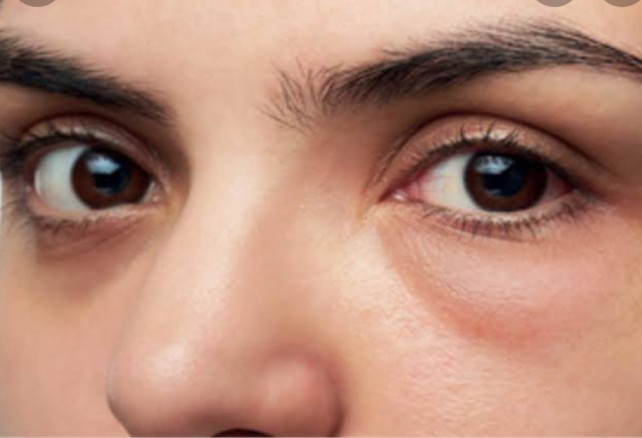 Understand the Causes of Puffy Eyes and Find Relief- Nikon