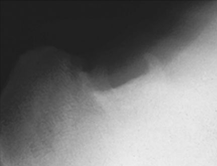 "Skyline" radiographic view showing reactive osseus proliferation within the intertubercular groove commonly seen with biceps tenosynovitis