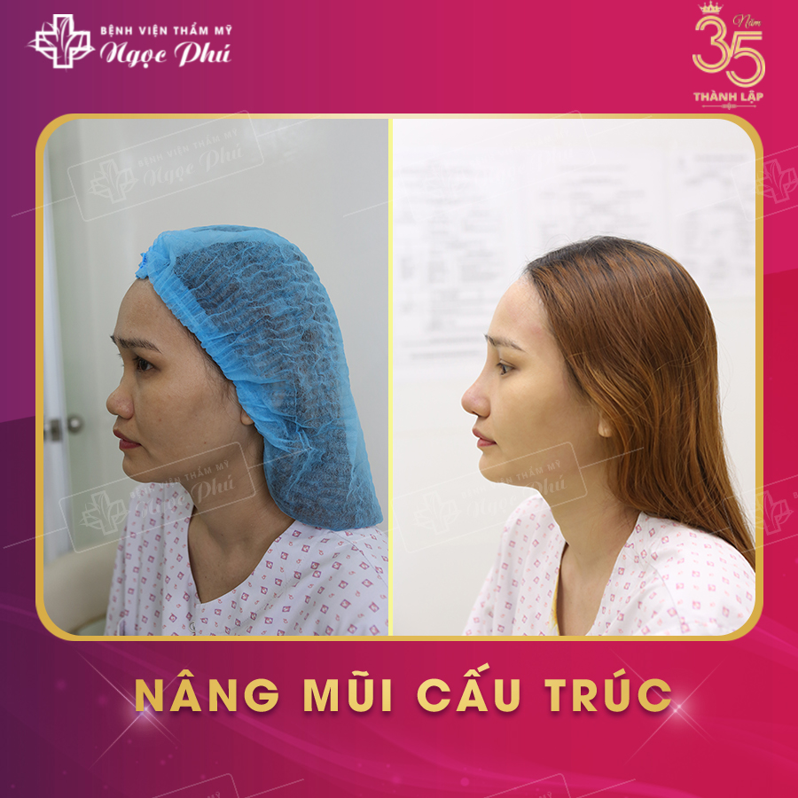 Khách hàng thực tế nâng mũi tại Thẩm Mỹ Việt Nam