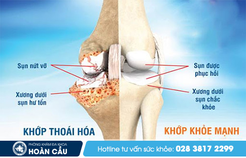 Bệnh lý xương khớp thường gặp - Đa khoa Hoàn Cầu  Jue4TR-i-Xtd8d0NORalX92YwsRdS0R2Gf52OVezHay7irCbTfcvFgEO8STJ5jwlWxANpT-v61vTLLLKfd1rB6U9QAjaSMFlDLGjC18Jg_O_9WKBiRmesqgfO6rL79BfEghY_DtLGZWahduZZpDPtCU