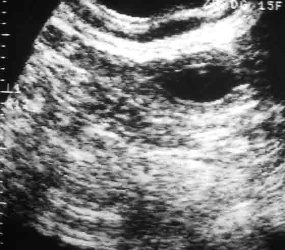 Día 23, vesícula uterina (saco gestacional) con embrión. 