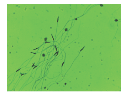 Espermatozoides de Stenorrhina f. Tinción eosina-nigrosina, con filtro a 40X. Se aprecian cabezas hinchadas en la parte superior derecha, al igual que agrupamiento de espermatozoides; conforme se va secando la muestra tienden a asociarse en formación.