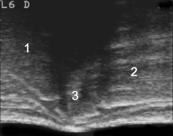 Median ultrasonographic scan of the lumbosacral junction of an 8-yr-old selle français male used for show jumping.