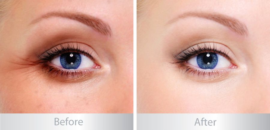 Có nên trị thâm quầng mắt bằng laser?  