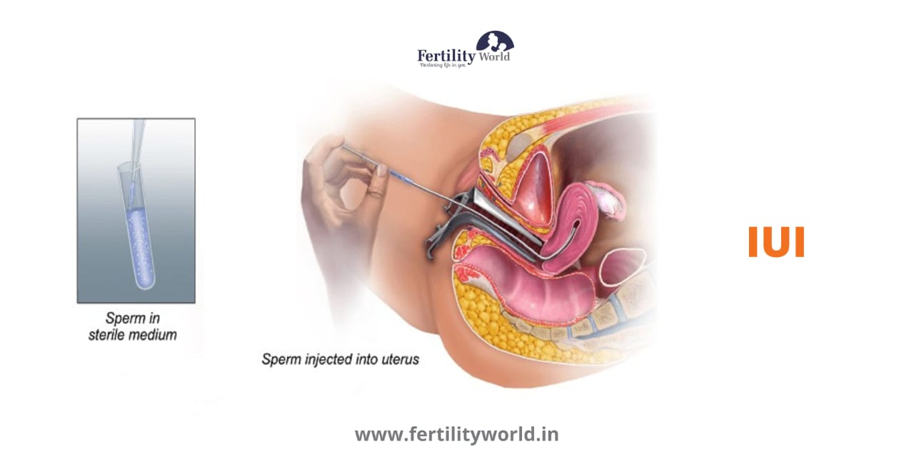 IUI cost in Dehradun