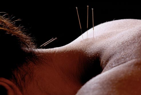 neck acupuncture