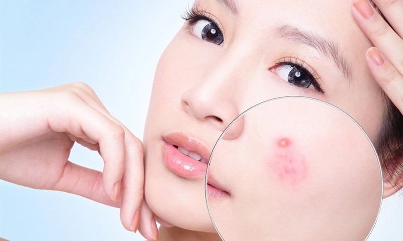Cung cấp ẩm cho da mặt giúp ngăn ngừa mụn hình thành