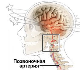 Синдром вертебральной артерии