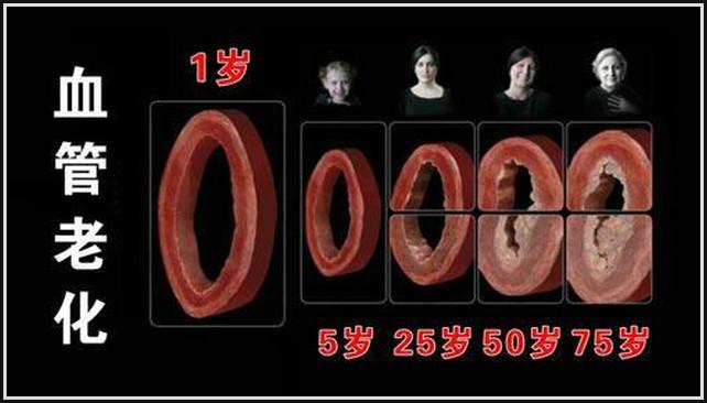专家：血管老化和去除动脉粥样硬化斑块的方法 - 閒靜 - √