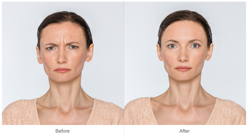 How Often Do You Need To Get Botox