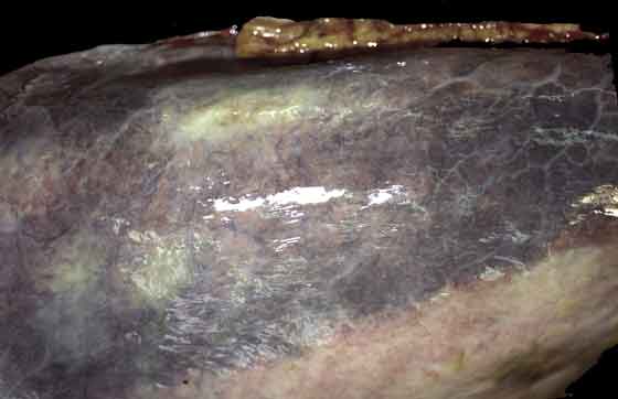 Closer view of Figure 45. The brown discolouration is caused by accumulated iron pigments as a result of repetitive episodes of hemorrhage.