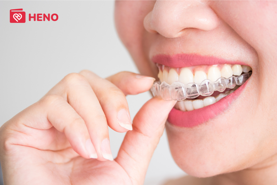 Niềng răng trong suốt Invisalign là một bước tiến đột phá trong công nghệ nha khoa thẩm mỹ