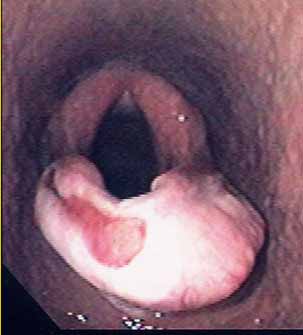 Approximately one year later, the same horse presented with an entrapment of the epiglottis. The mucosal surface of the entrapment is ulcerated on the right side.