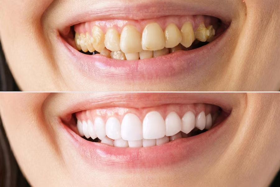Dental Veneers in Thailand Know The Best Clinics, Surgeons, Cost & More ClinicSpots