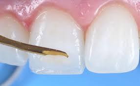 Bio-additive treatment in anterior teeth Tratamiento bioaditivo en dientes  anteriores