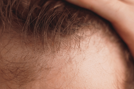 How to Take Care of Your Hair After Hair Transplant