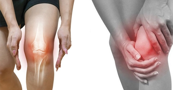 Điều trị viêm khớp gối