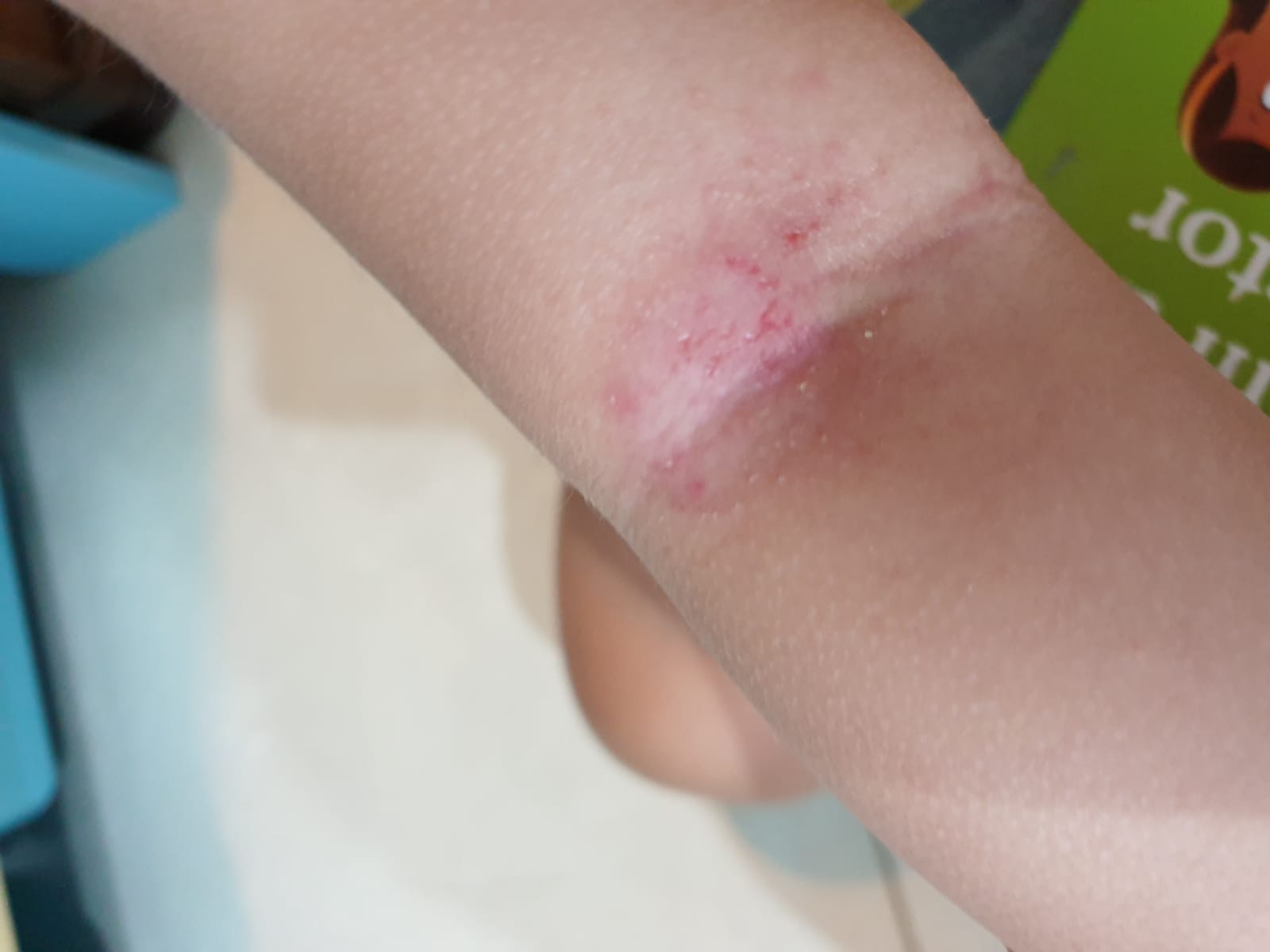 Above: Another view of baby’s eczema on inside elbow