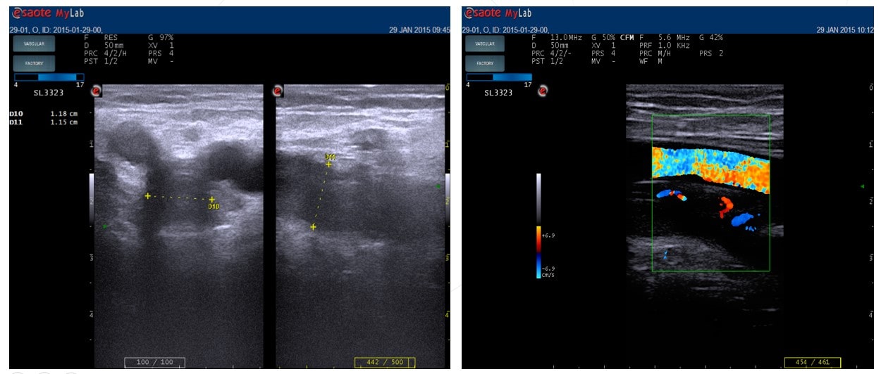 Why is a duplex scanning of the veins of the lower extremities necessary?