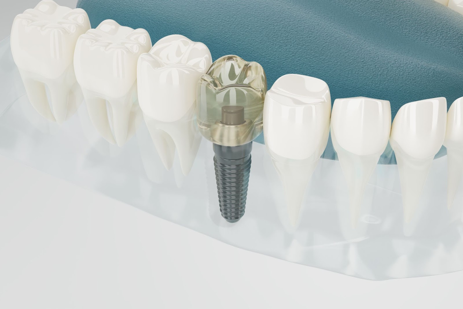 Dental implants that replace a full arch of missing teeth