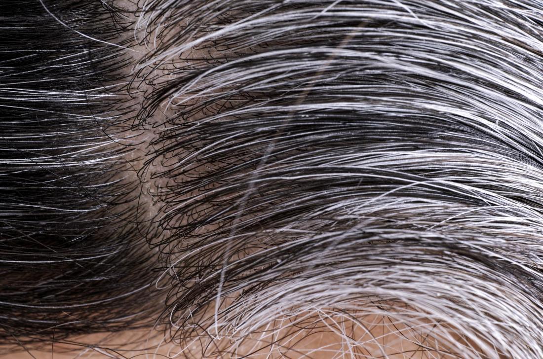 White and gray hairs growing on person's head.