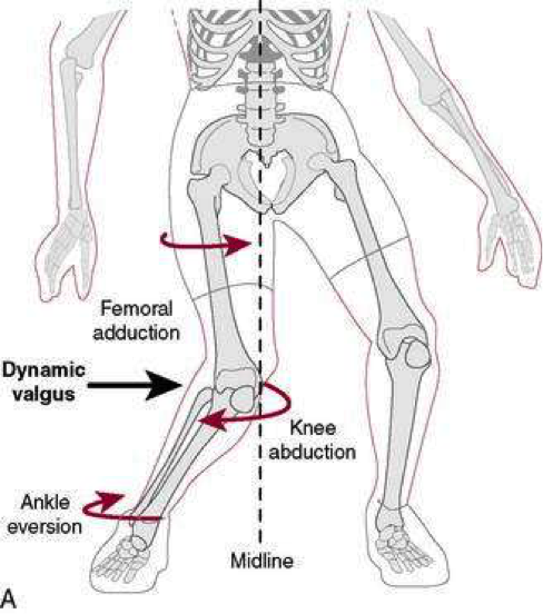 neuromuscular control deficit 