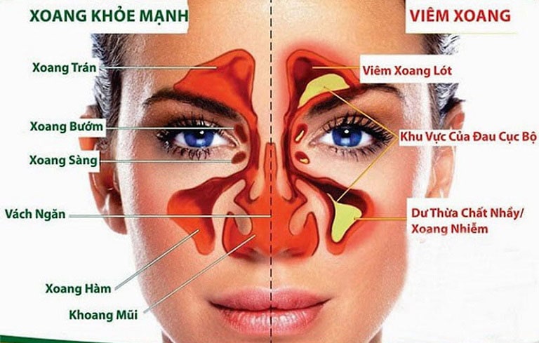 Viêm xoang là tình trạng sưng nề, viêm nhiễm lớp lót trong hốc xoang Viêm xoang là tình trạng sưng nề, viêm nhiễm lớp lót trong hốc xoang