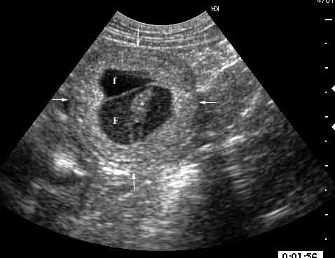 Embryo undergoing resorption at mid gestation