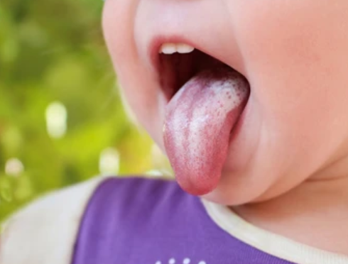 Infants often suffer from thrush more frequently than any other oral fungal illness. Even though it is not a life-threatening condition, it may be somewhat uncomfortable.