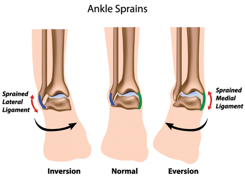  types of ankle sprain ligaments