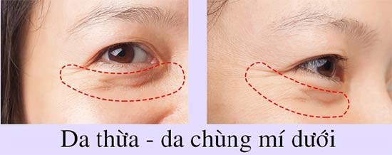 Da thừa, da chùng mí dưới