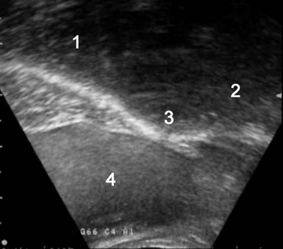 Reference paramedian ultrasonographic scan of the intertransverse lumbosacral joint of an 8-yr-old French trotter female used for racing.