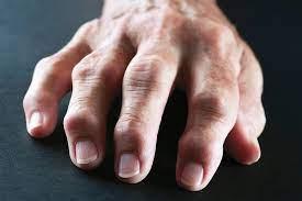arthritis2.jpg