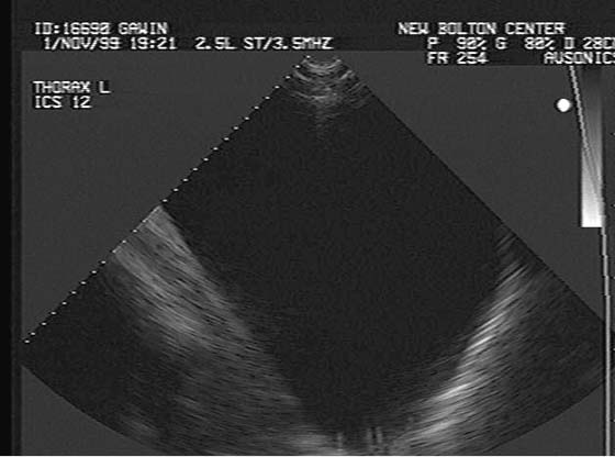 Sonographic appearance of large volume of anechoic pleural fluid.
