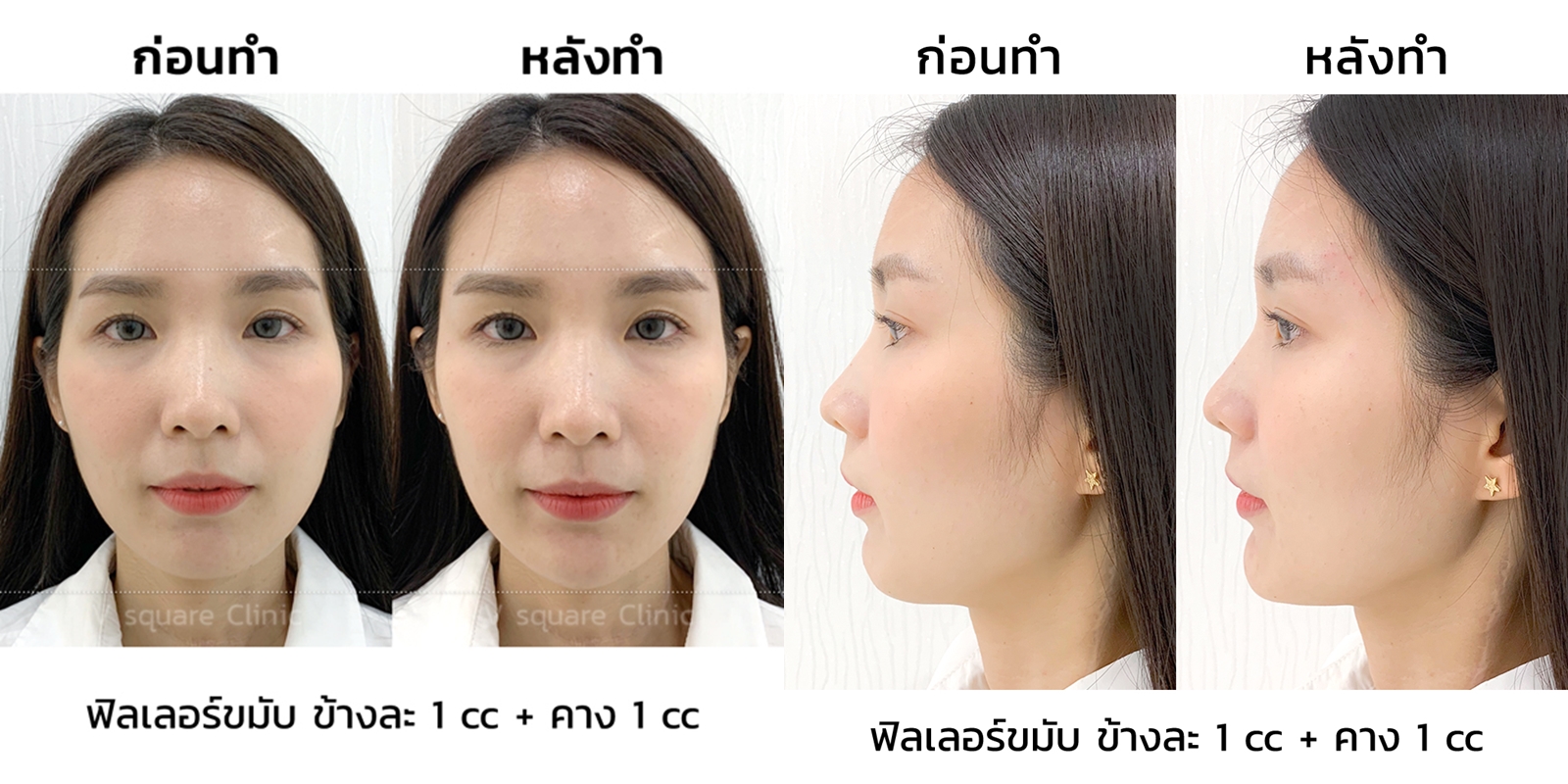 รีวิวฟิลเลอร์ขมับ