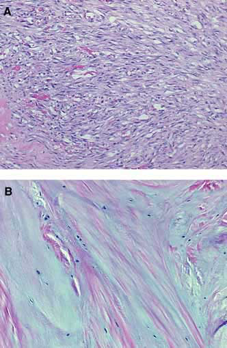 Photomicrographs of the proximal suspensory ligament from a horse with chronic suspensory desmitis (H&E stain) and failure of fetlock support. Regions of fibroblast proliferation and increased vascularity (A) are adjacent to areas of metaplasia that are acellular and avascular with no evidence of healing. 