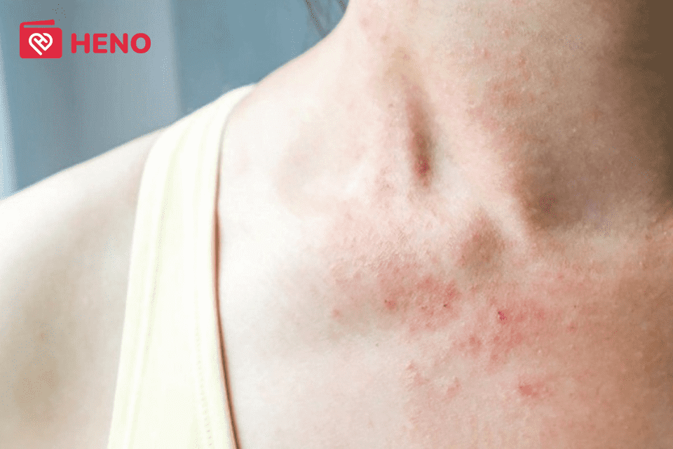 Da kích ứng mẩn đỏ do nhiều nguyên nhân gây ra