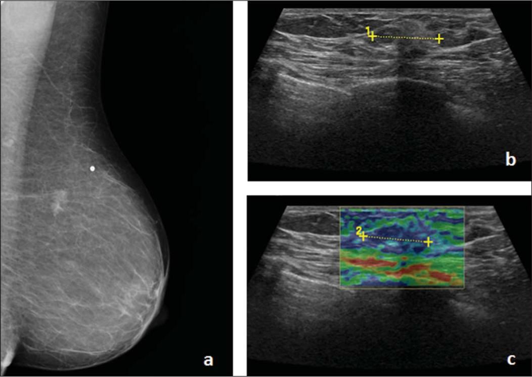 Paciente de 55 anos de idade, sem antecedentes de câncer da mama. Foi detectada uma densidade assimétrica na mama esquerda no ano de 2011, tendo esta aumentado de dimensões recentemente. Realizou mamografia de rastreio, na qual foi detectada a alteração ao nível do tecido mamário anteriormente referida. 