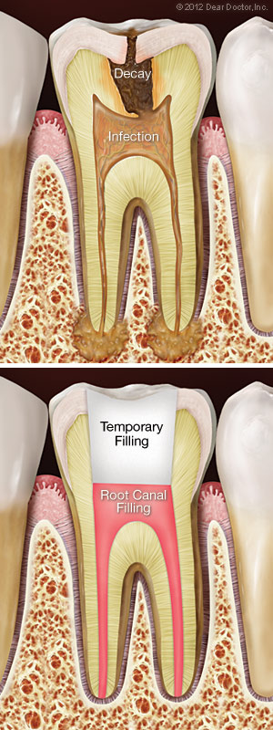 Root canal treatment. Root canal treatment.
