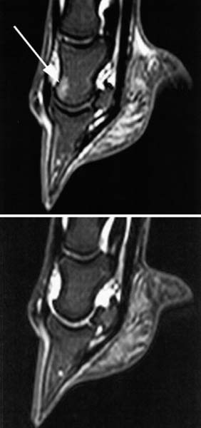 These are sagittal STIR images of the front feet from a horse that has a contusion in the subchondral bone of the middle phalanx (P-2) in the lame left forelimb (arrow).